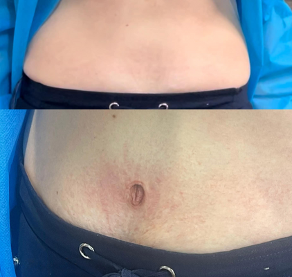 Comparison of the abdominal area before and after receiving a realistic belly button tattoo following surgery