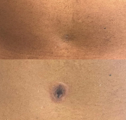 belly button tattoo camouflage after tummy tuck

