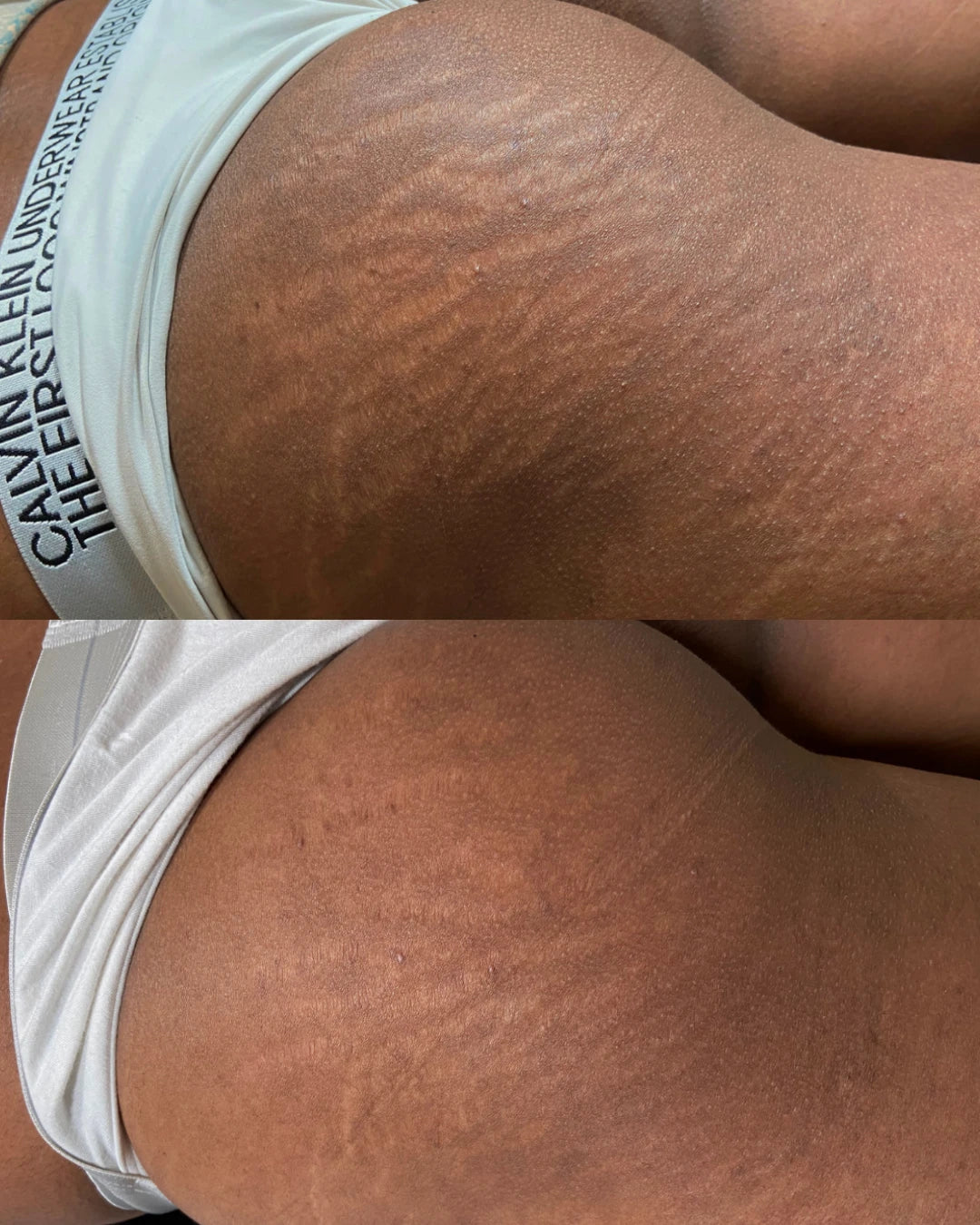 Before and after: stretch marks on the buttocks softened after one session of restorative needling