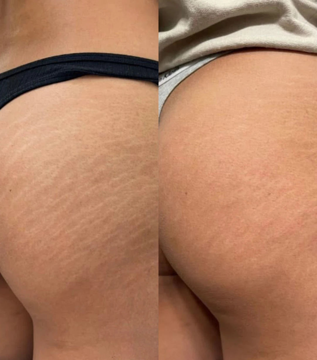 Before and after: pale stretch marks on the buttocks softened after one session