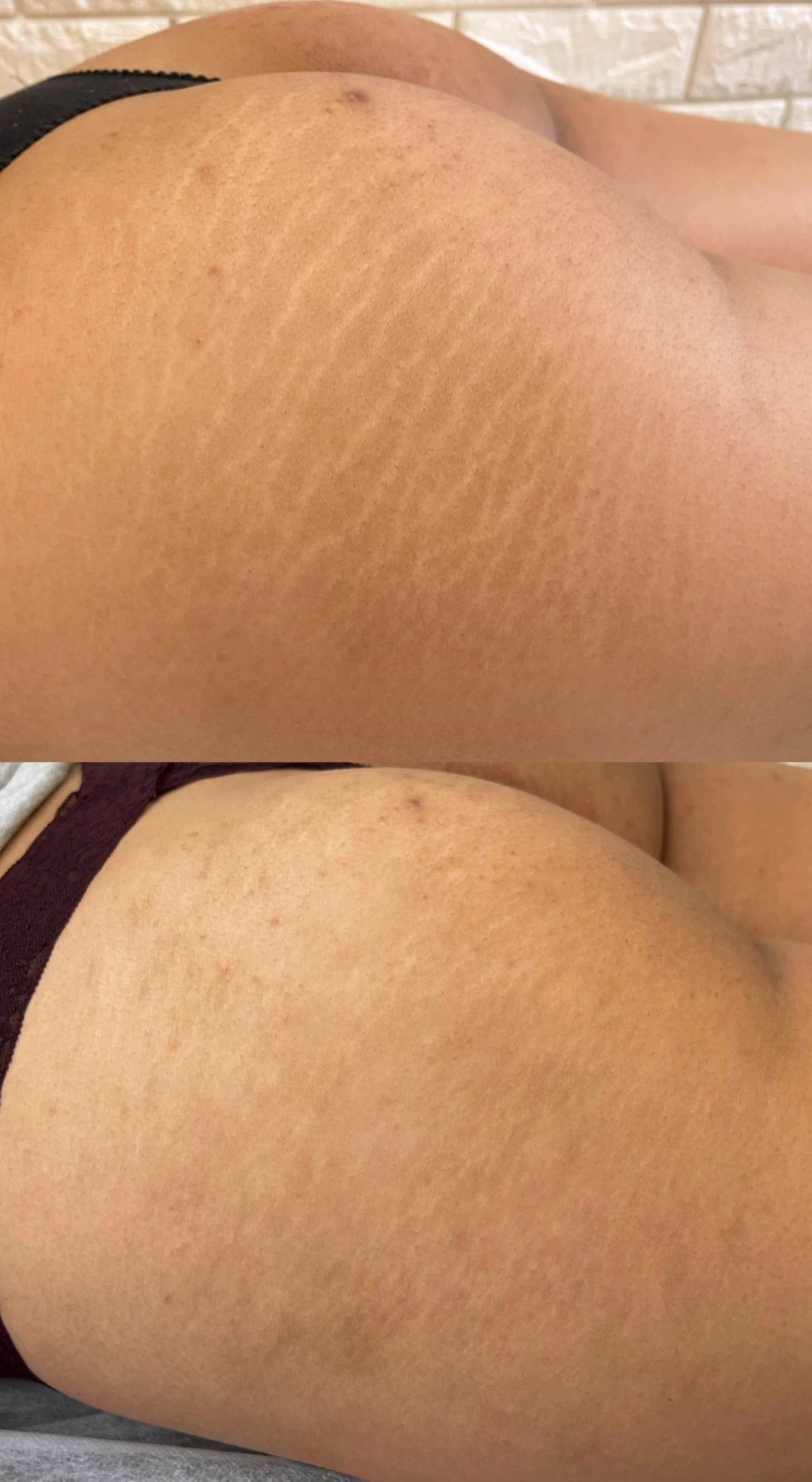 Before and after: textured stretch marks on the buttocks softened after one session