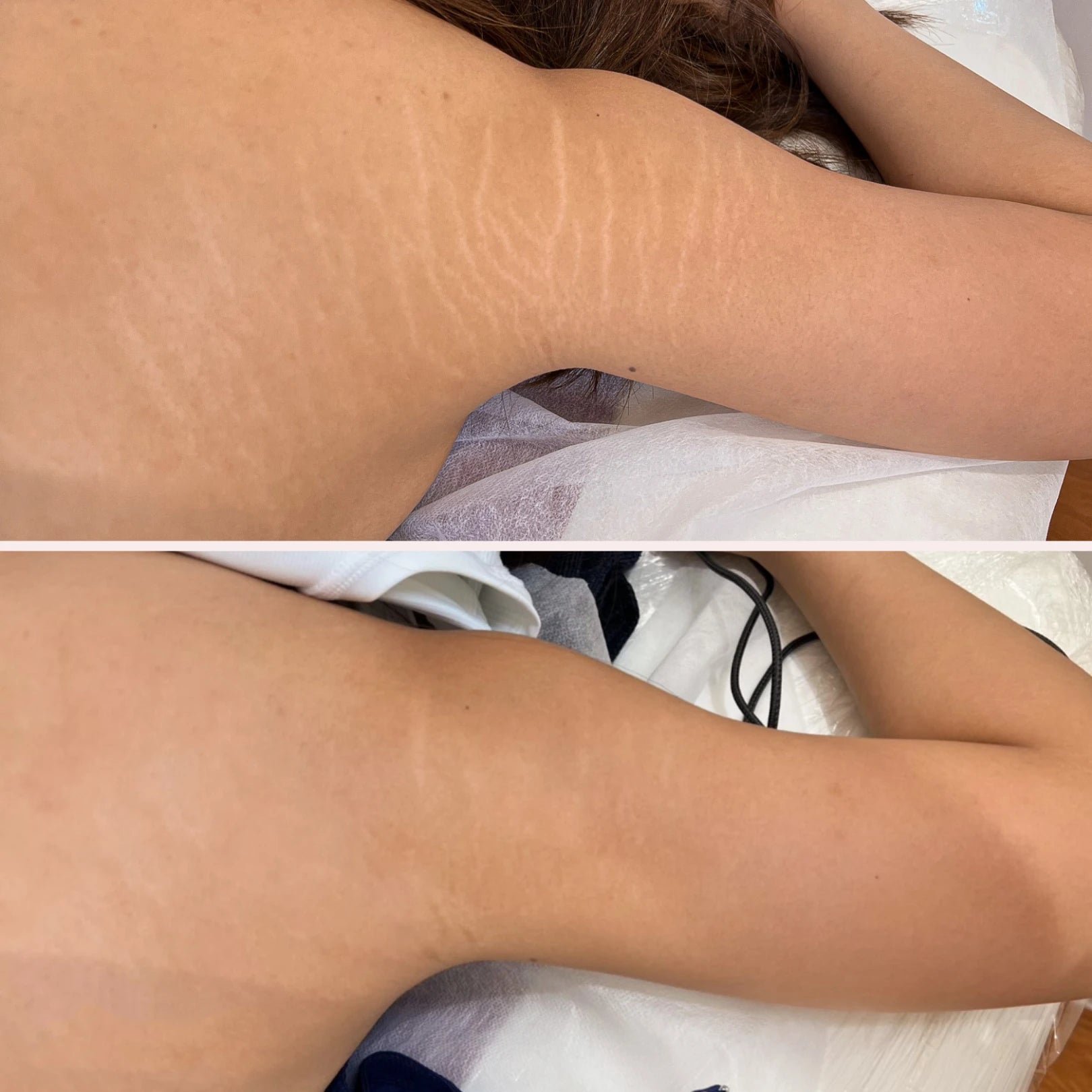 Before and after: textured stretch marks on the shoulder softened after two sessions