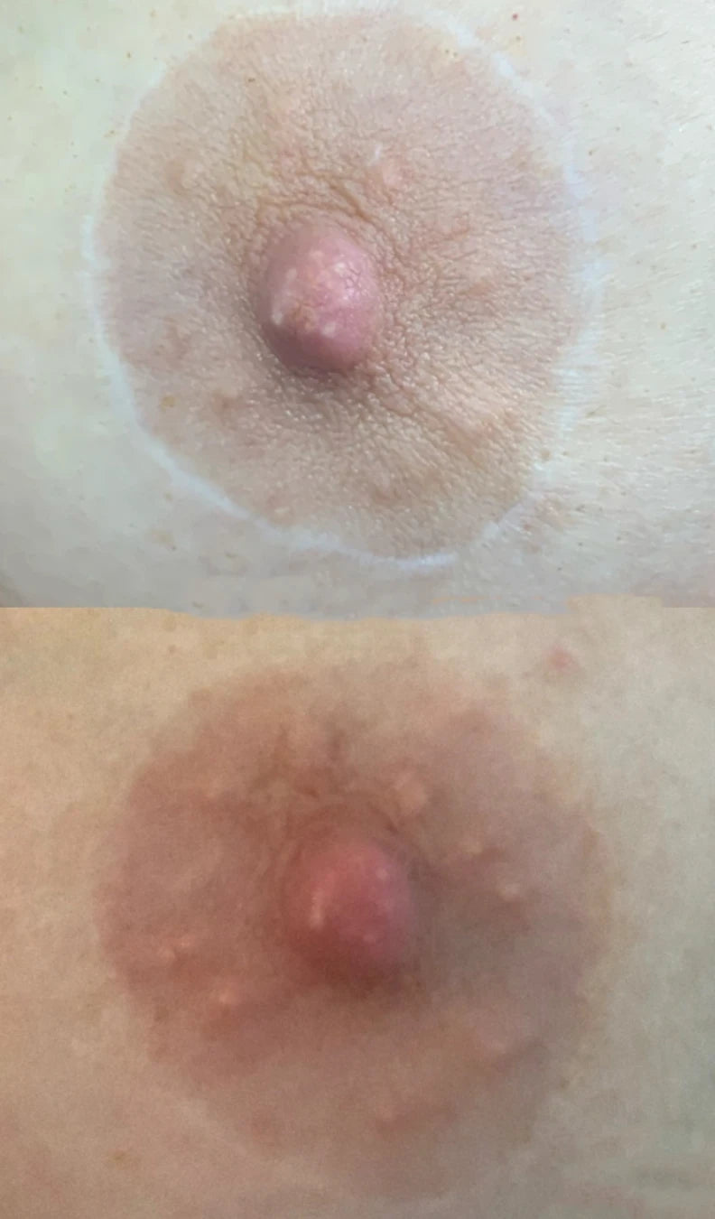 Before and after: a pale scar around the areola blended and its colour deepened with two sessions of pigment