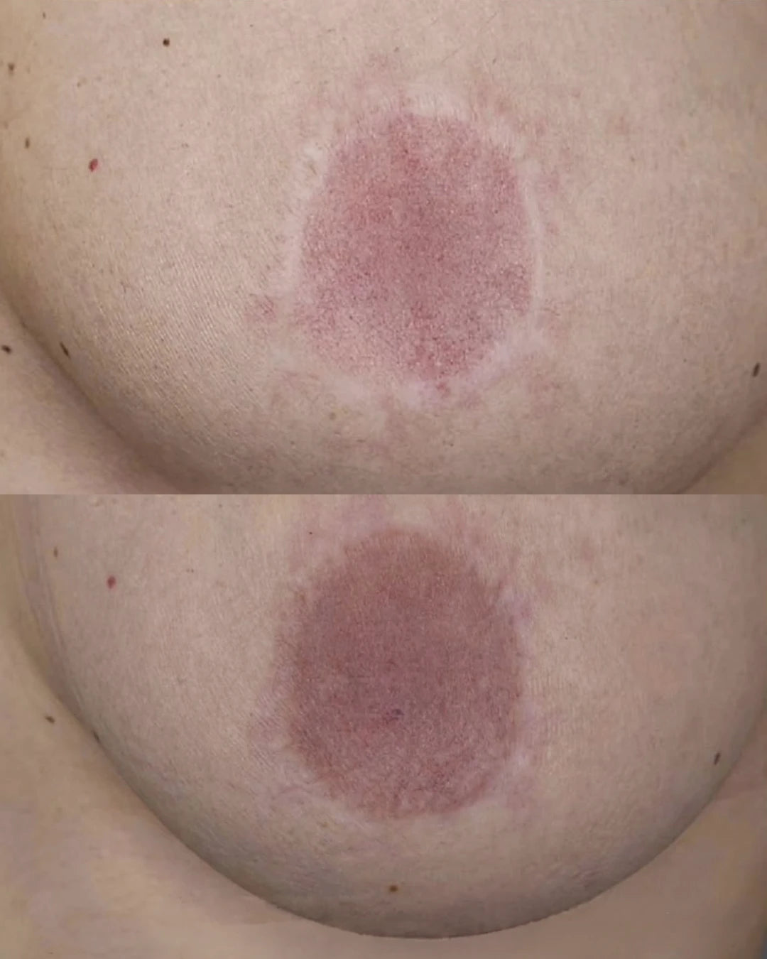 Before and after: scarring around the areola evened out with three sessions of pigment camouflage