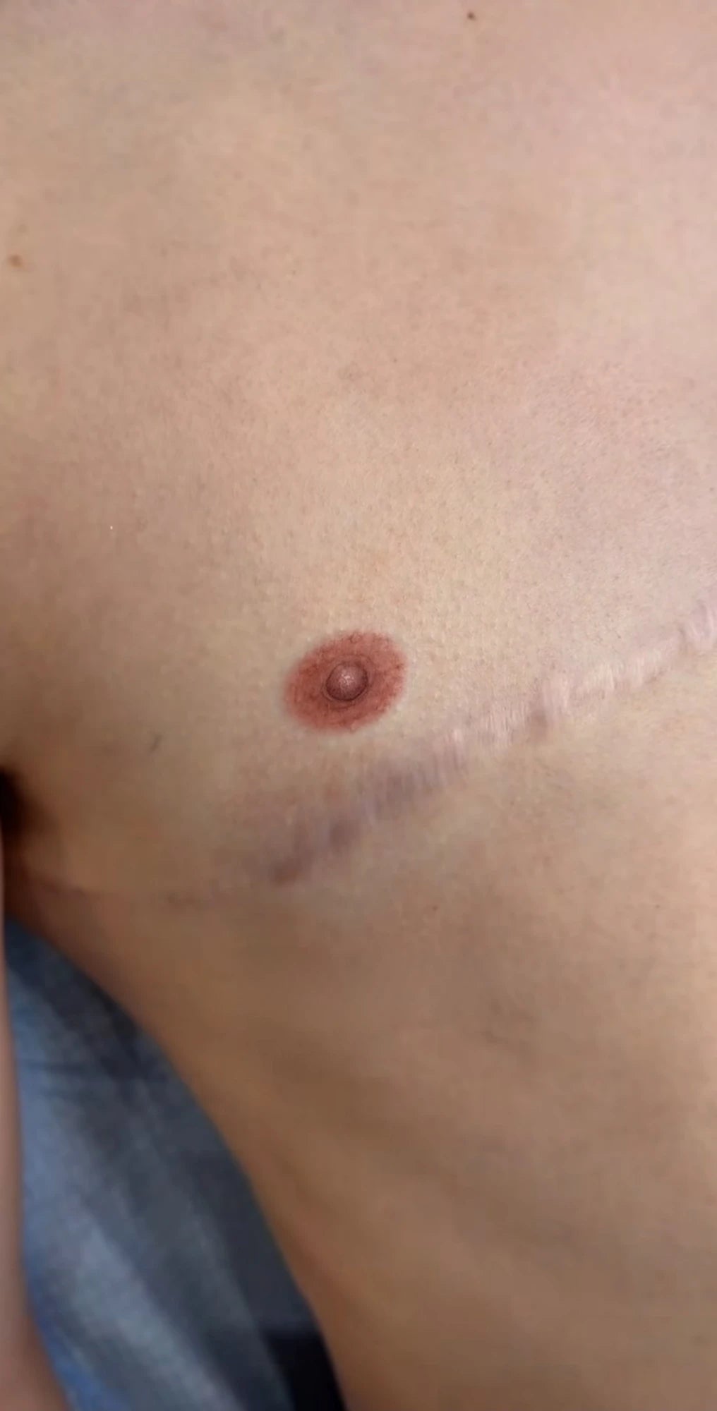 A healed, realistic areola and nipple tattoo on a chest, beside a surgical scar