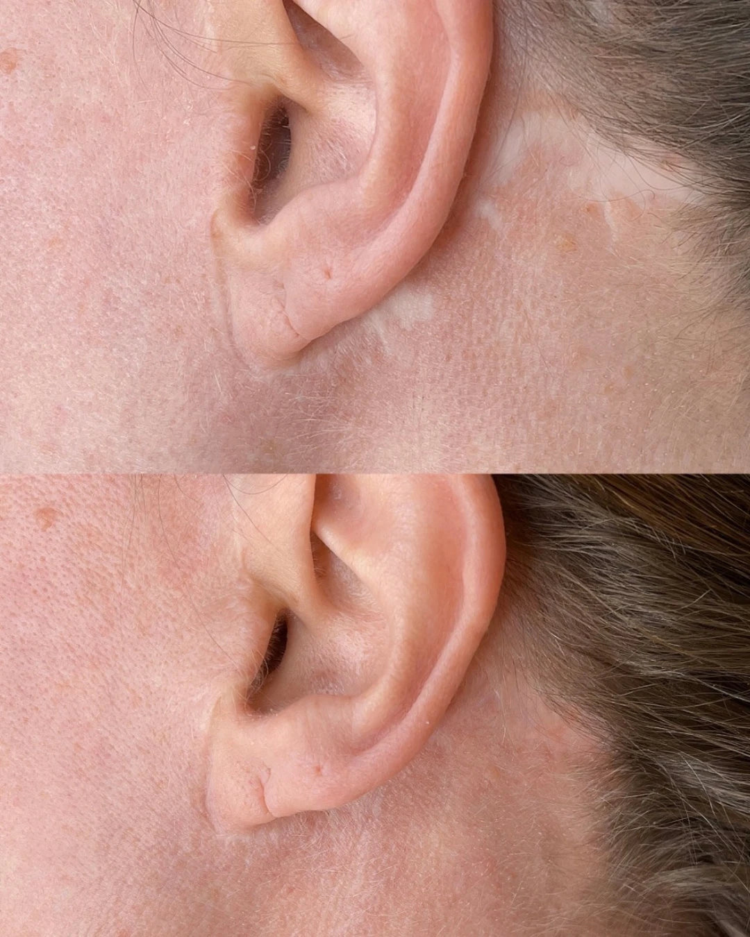 Before and after: a pale scar beside the ear softened with restorative needling and scar camouflage