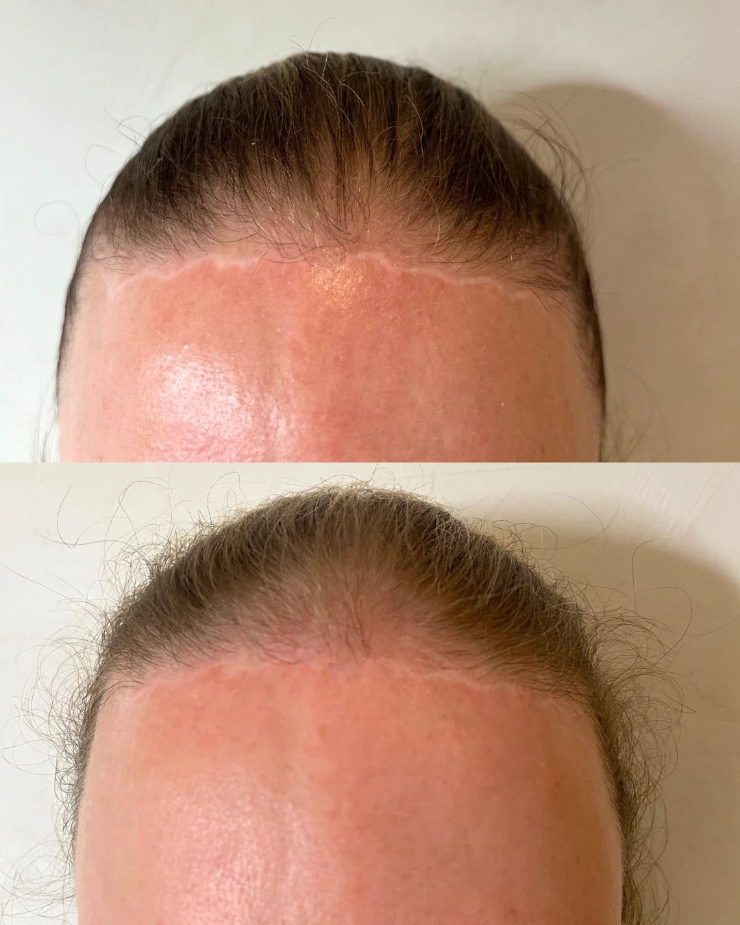 Before and after: a forehead lift scar along the hairline softened with restorative needling