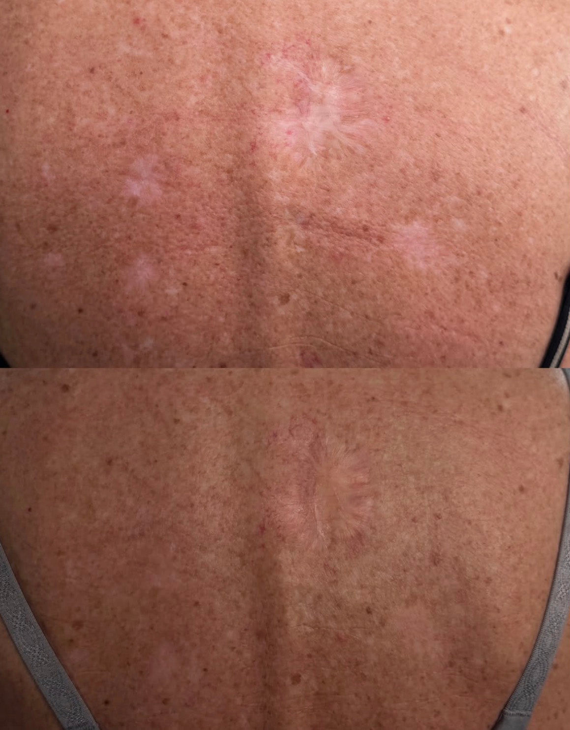 Before and after: pale skin cancer removal scars on the back blended with camouflage pigment