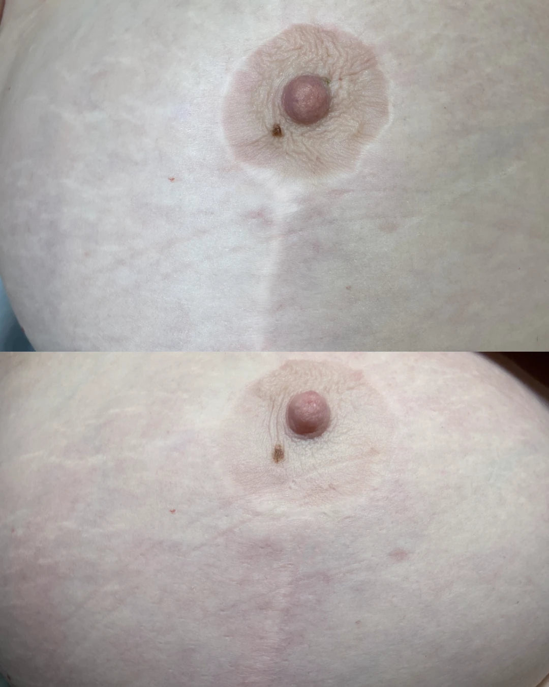 Before and after: breast lift scars around and below the areola blended with needling and pigment camouflage