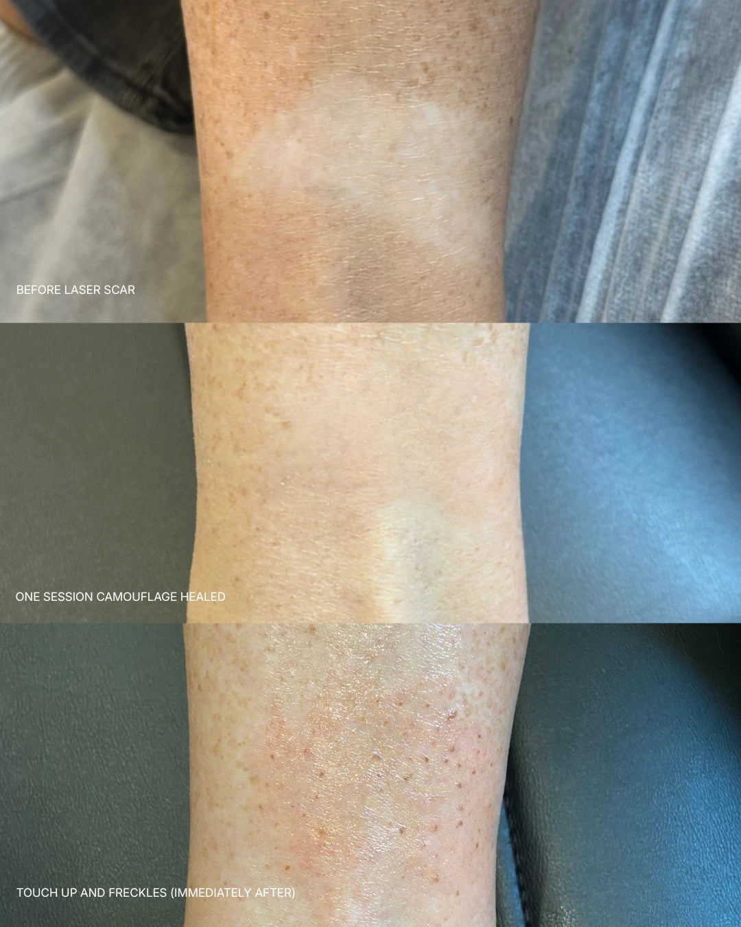 Before, healed and touch-up: a pale laser removal scar on the arm blended with pigment camouflage and freckles