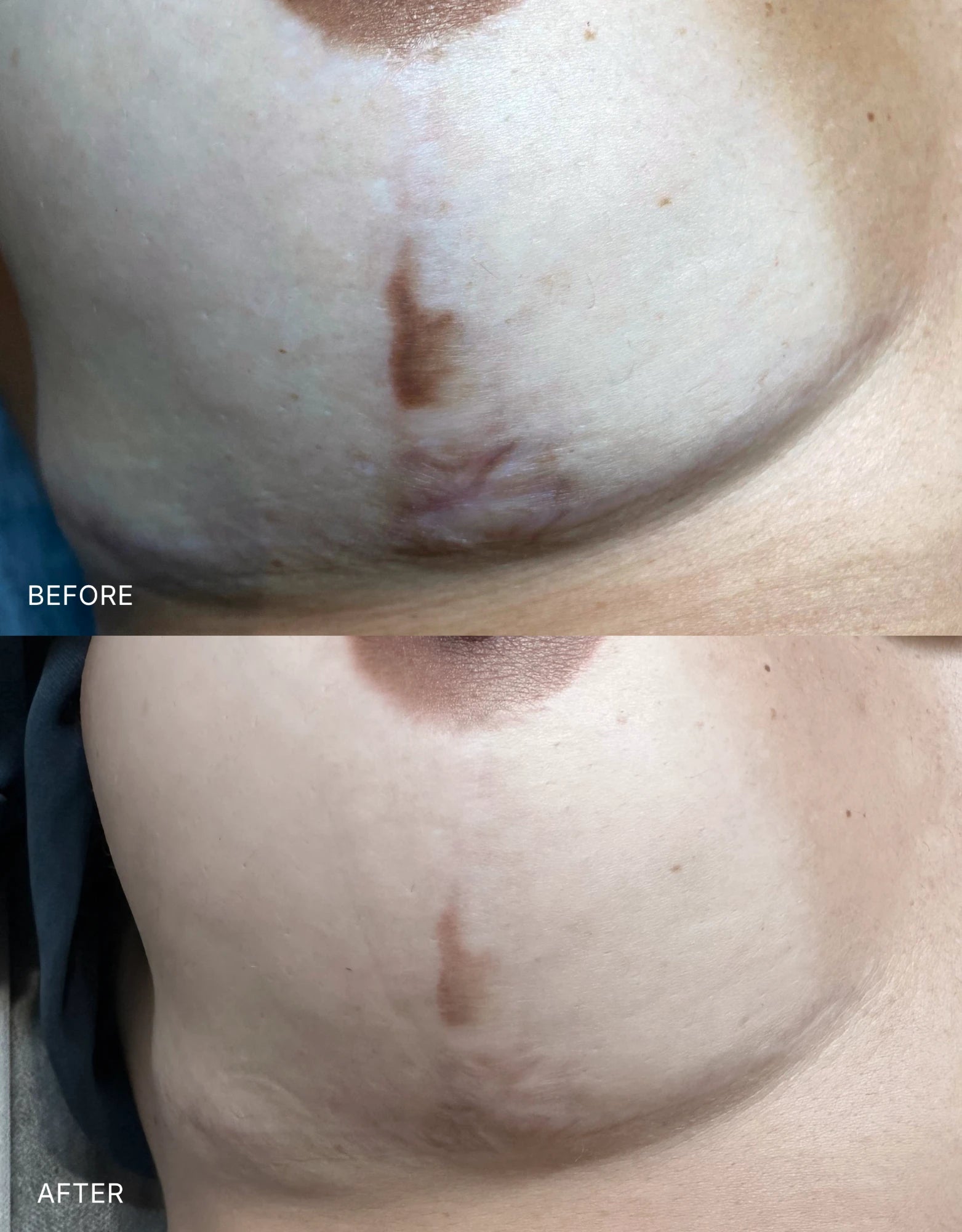 Before and after: a dark breast lift scar below the areola softened with needling and pigment neutralisation
