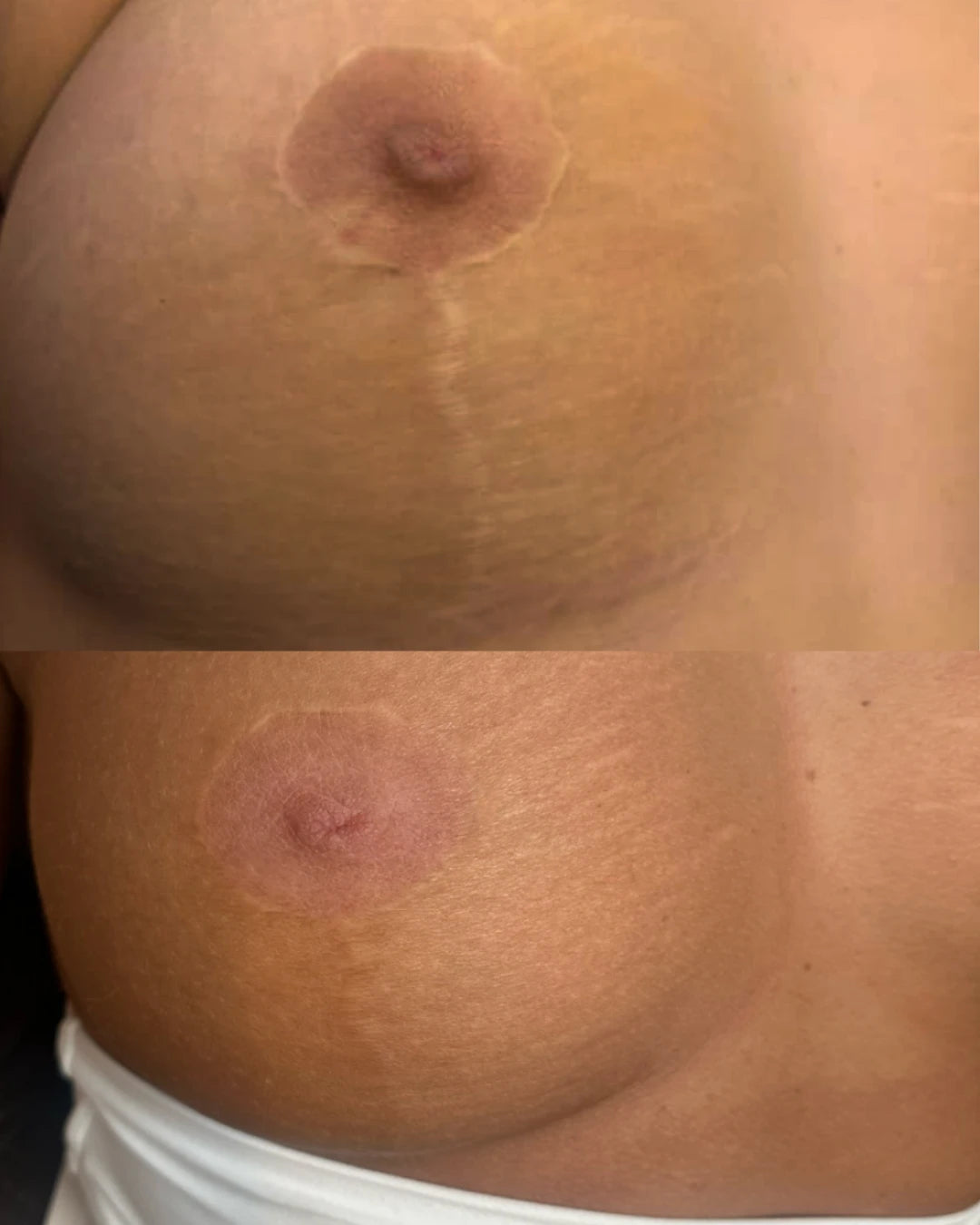 Before and after: breast lift scars and areola softened with restorative needling and pigment camouflage