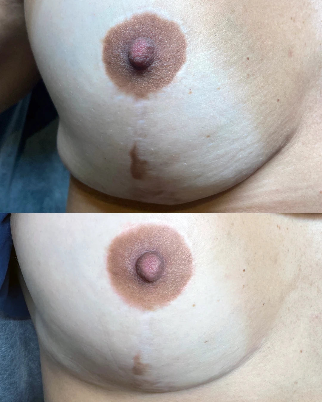 Before and after: breast lift scars below the areola blended with restorative needling and pigment camouflage