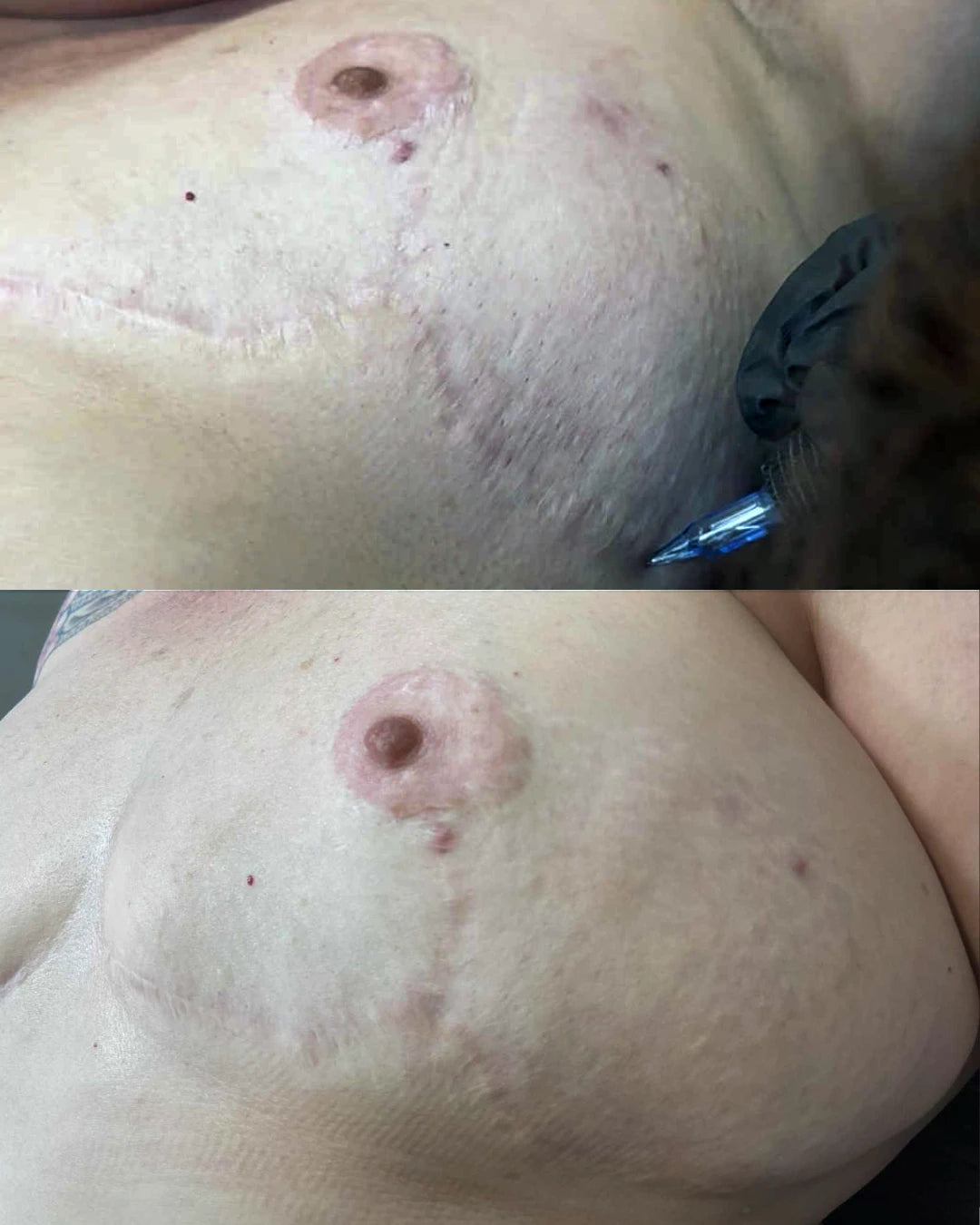 Before and after: textured breast scars softened with three sessions of restorative needling