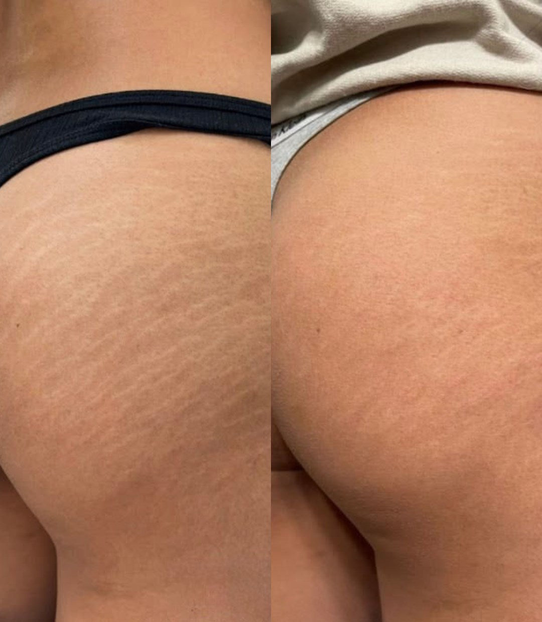Before and after: pale stretch marks on the buttocks blended with pigment camouflage