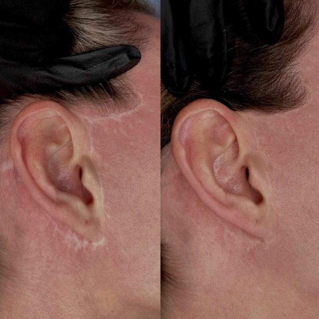 Before and after: pale facelift scars around the ear blended with pigment camouflage