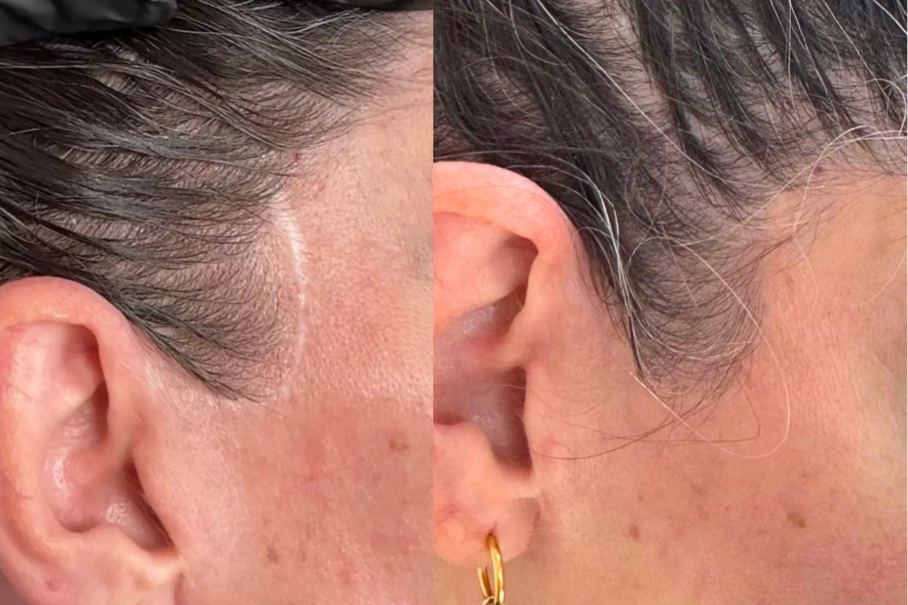 Before and after: a pale facelift scar at the hairline in front of the ear blended with pigment camouflage