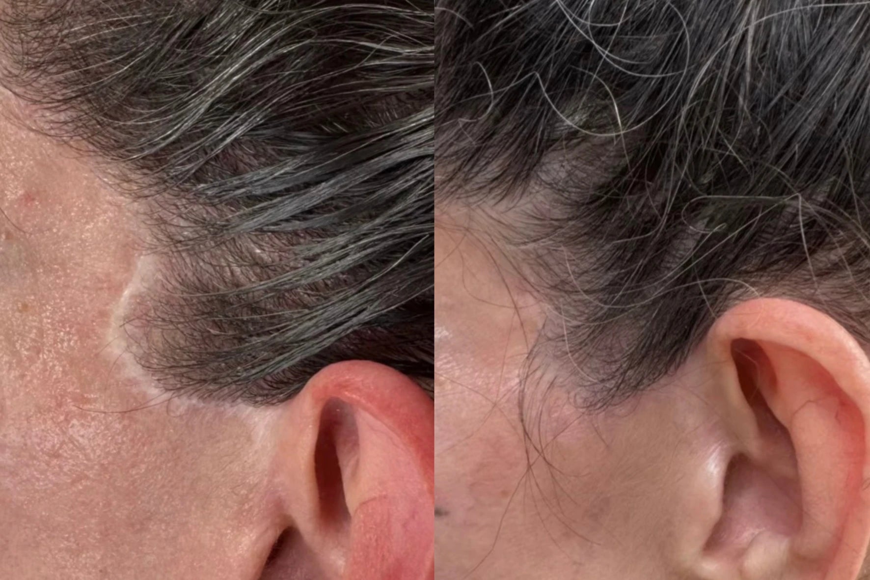 Before and after: a pale facelift scar along the temple hairline blended with pigment camouflage
