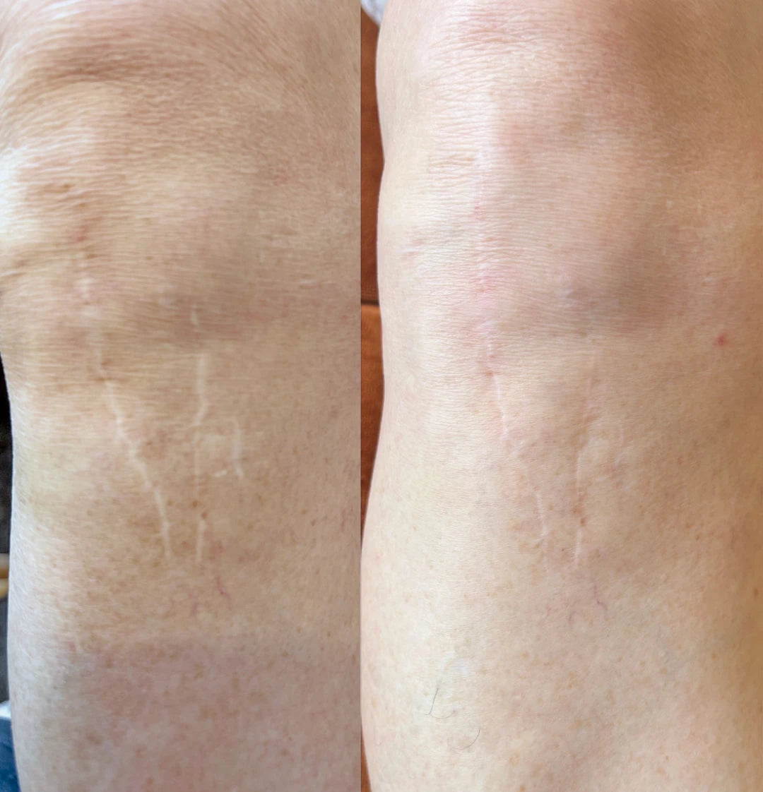 Before and after: thin white scars on the knee softened with restorative needling