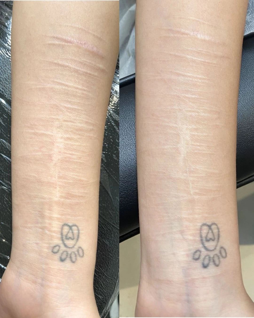 Before and after: raised self-harm scars on the forearm softened and blended