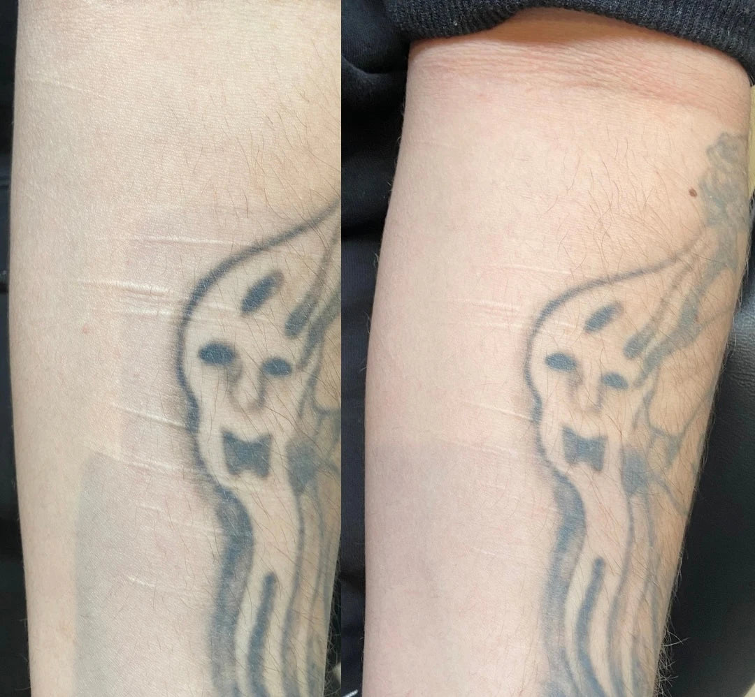 Before and after: pale self-harm scars beside a tattoo softened and blended