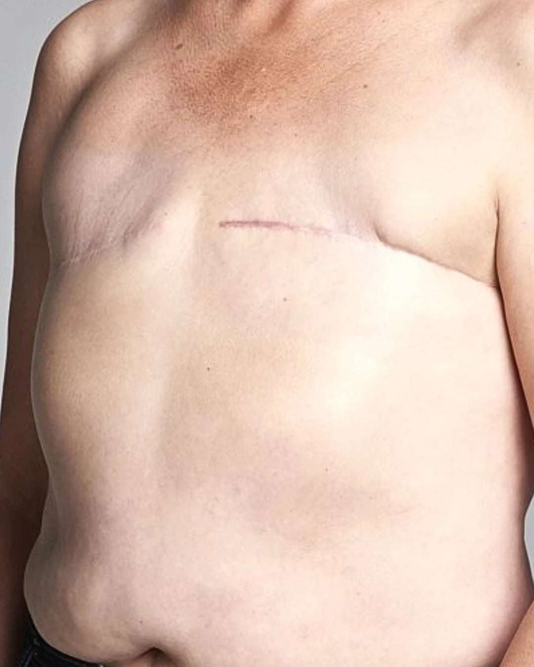 Flat chest after mastectomy, with fine surgical scars across the chest