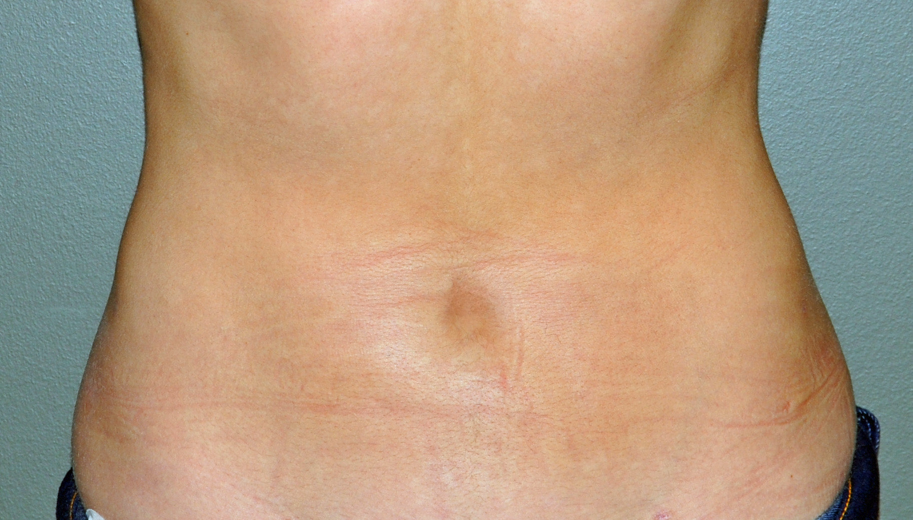 Abdomen with a natural-looking belly button and faint stretch marks