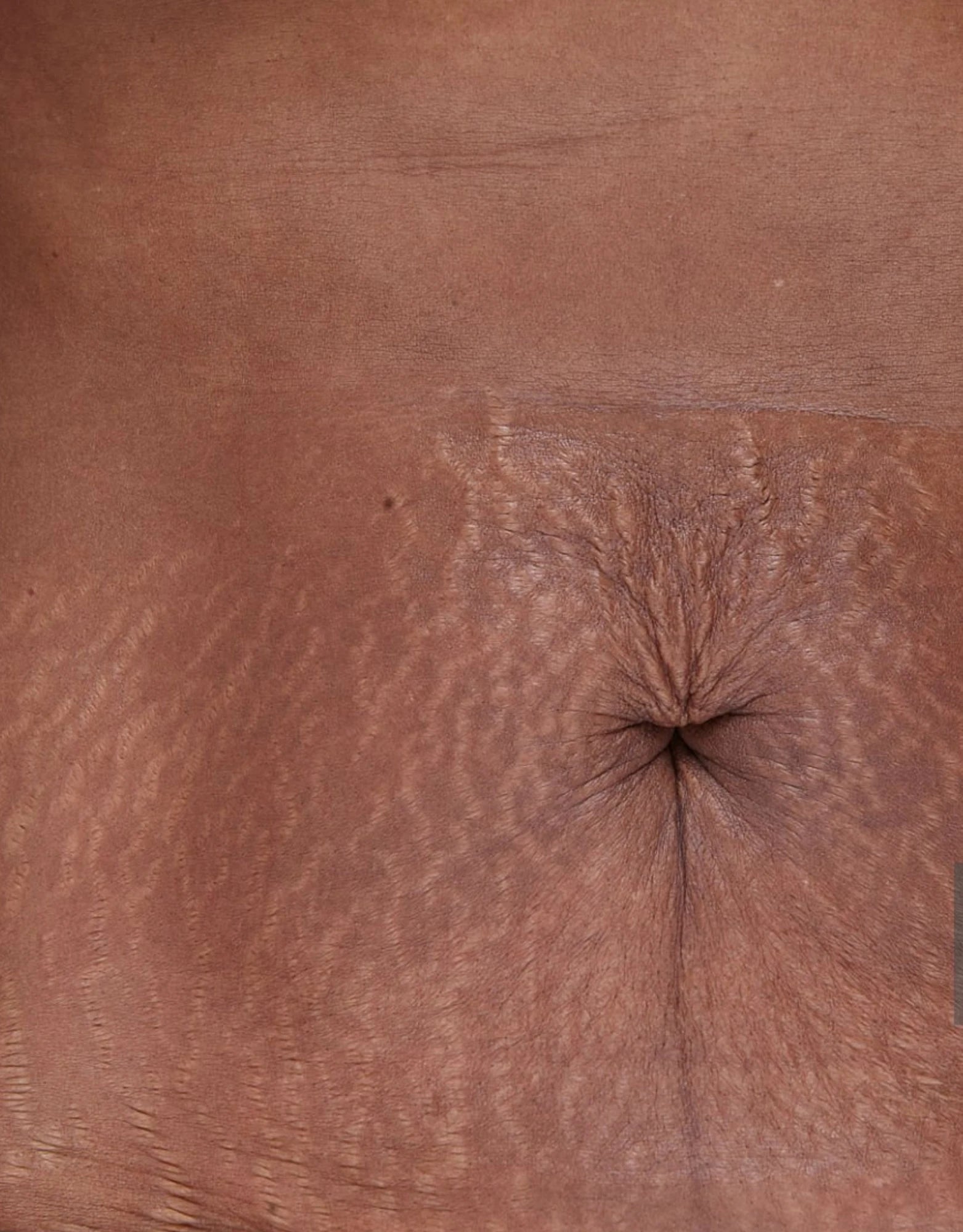 Close-up of textured stretch marks around the navel