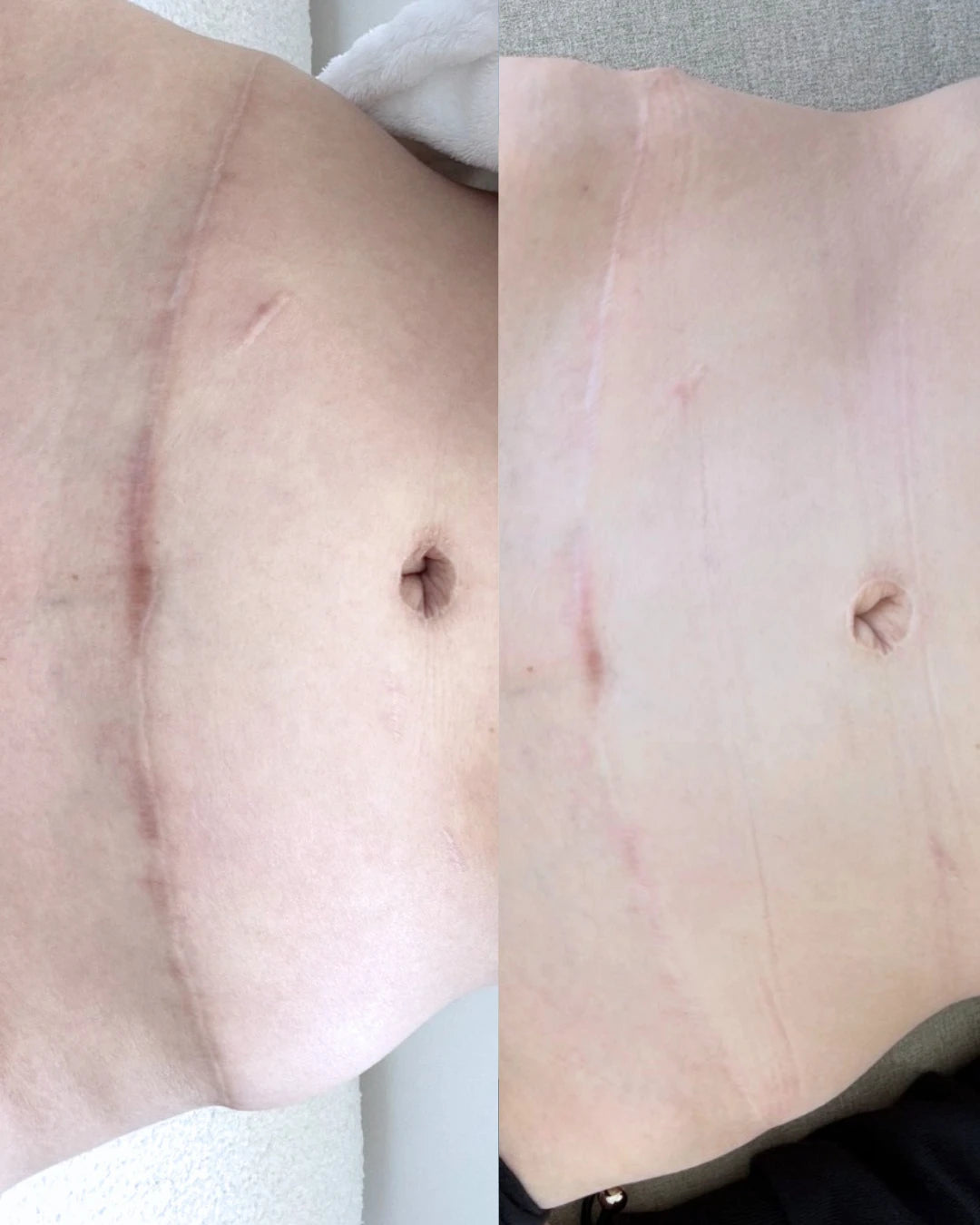 Before and after: a tummy tuck scar and smaller surgical scars softened and blended